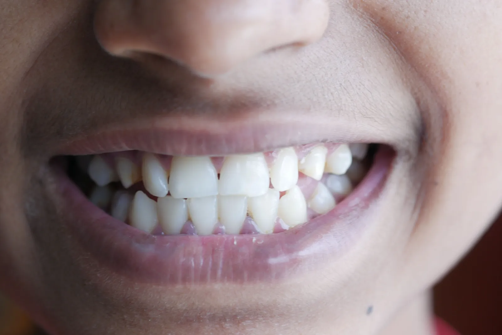 Nærbilde av et smil med tenner og lepper